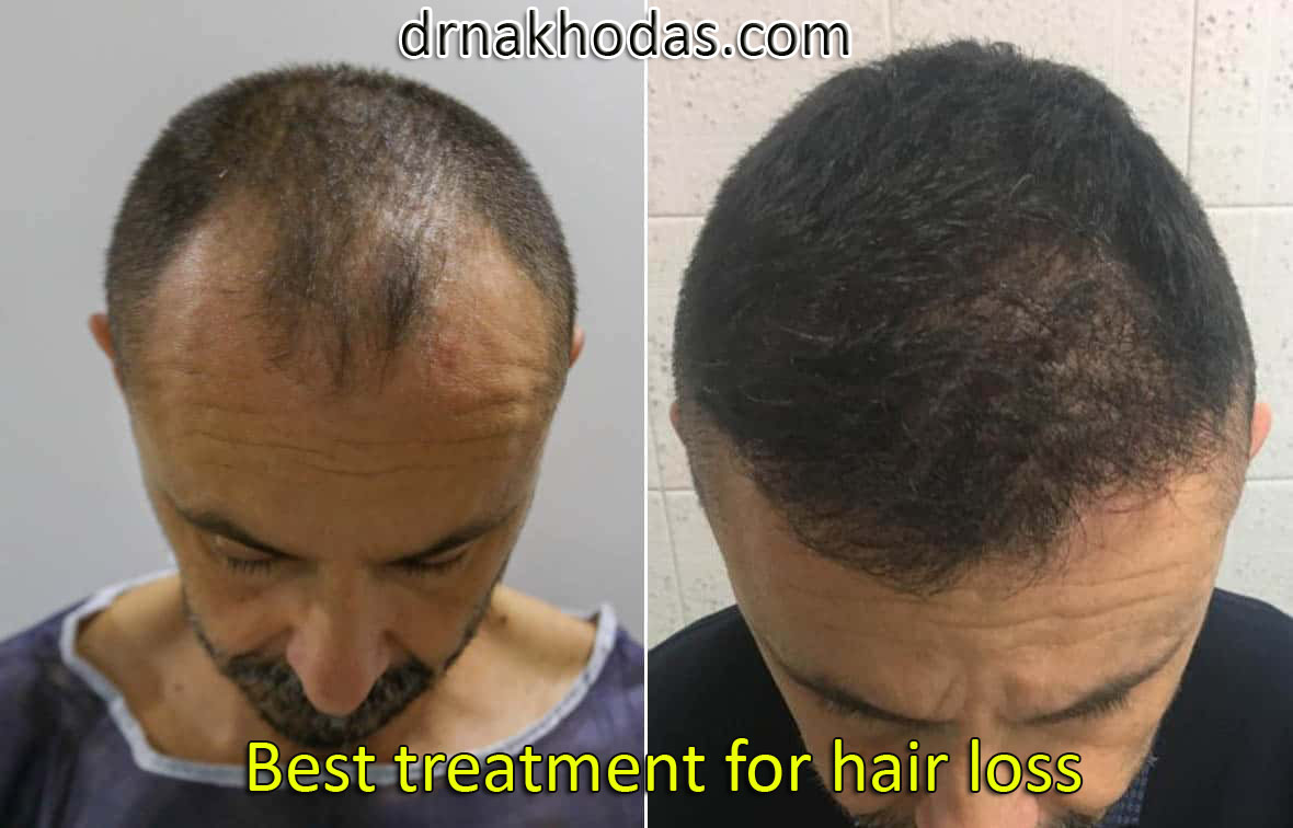 What is the best kind of treatment for hair loss?