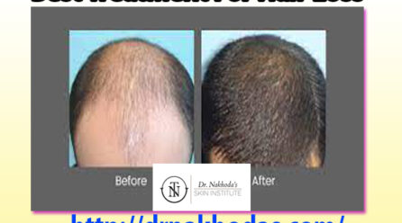 Determining The Best Treatment For Hair Loss