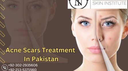 Is Revlite Treatment In Karachi For Acne Scars Right For You? Here’s Everything You Need To Know